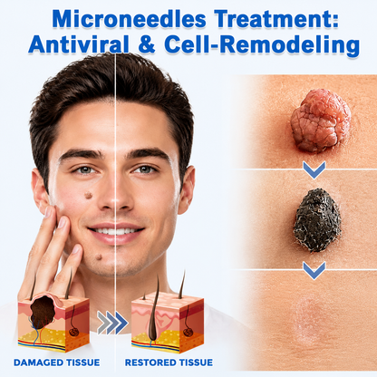 ✨Simpleahaven®2-in-1 Microneedle & Hydrocolloid Patch🍀| Removes Raised Moles, Acne, Flat Warts & Skin Tags | Helps Improve Wrinkles, Scars & Blemishes | Invisible Patches for Face & Body