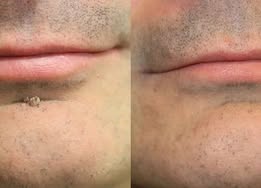 ✨Simpleahaven®2-in-1 Microneedle & Hydrocolloid Patch🍀| Removes Raised Moles, Acne, Flat Warts & Skin Tags | Helps Improve Wrinkles, Scars & Blemishes | Invisible Patches for Face & Body