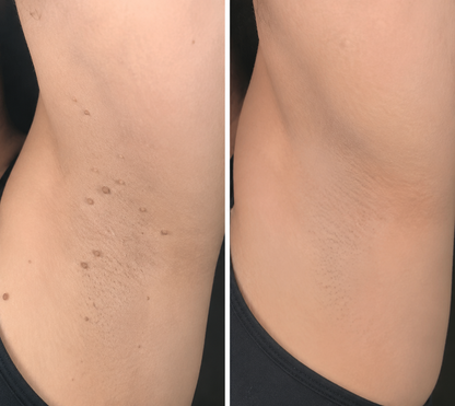 ✨Simpleahaven®2-in-1 Microneedle & Hydrocolloid Patch🍀| Removes Raised Moles, Acne, Flat Warts & Skin Tags | Helps Improve Wrinkles, Scars & Blemishes | Invisible Patches for Face & Body