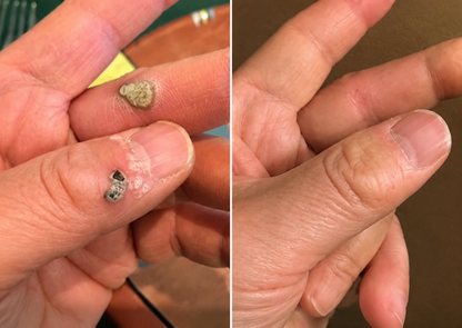 ✨Simpleahaven®2-in-1 Microneedle & Hydrocolloid Patch🍀| Removes Raised Moles, Acne, Flat Warts & Skin Tags | Helps Improve Wrinkles, Scars & Blemishes | Invisible Patches for Face & Body